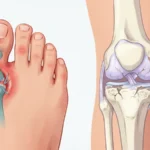 gout vs arthritis